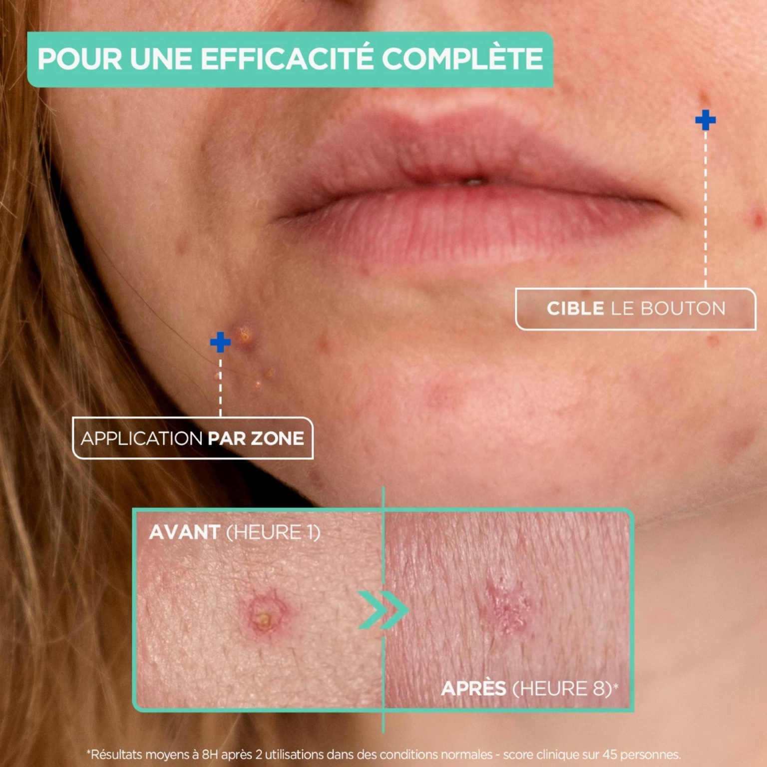 Mixa Expert Peau Sensible – Pâte Concentrée Anti-Boutons (15ml) 4 Mixa Expert Peau Sensible – Pâte Concentrée Anti-Boutons (15ml) – vue 4